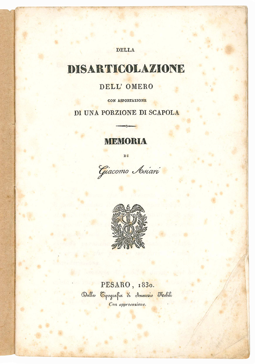 Della disarticolazione dell'omero con asportazione di una porzione di scapola.