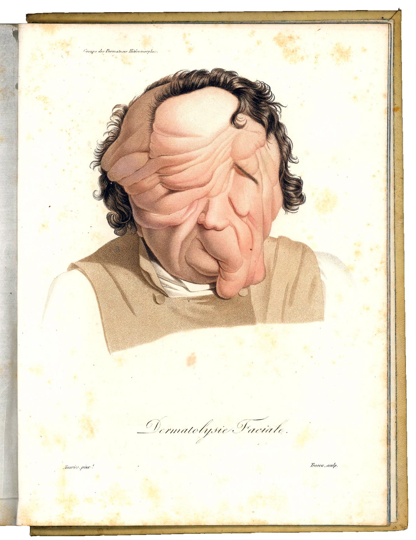 Monographie des dermatoses ou precis theorique et pratique des maladies …