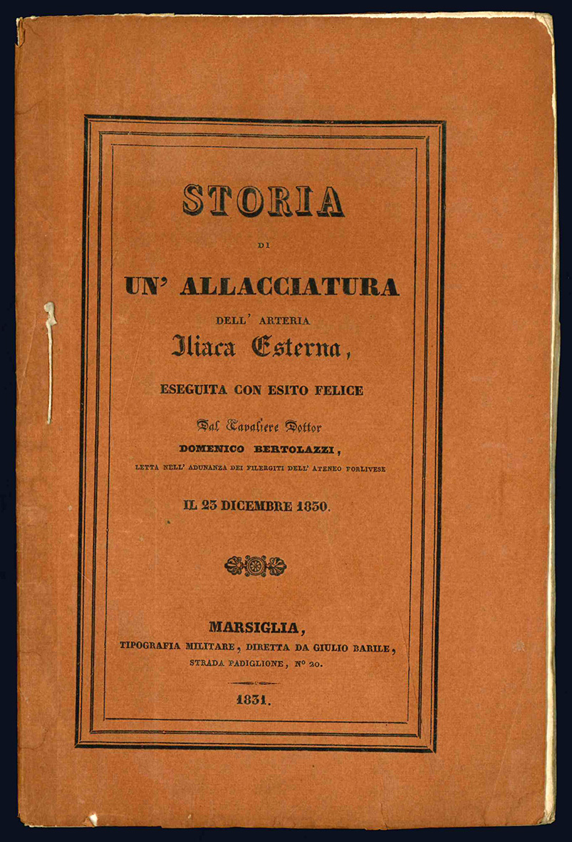 Storia di un'allacciatura dell'arteria iliaca esterna, eseguita con esito felice …