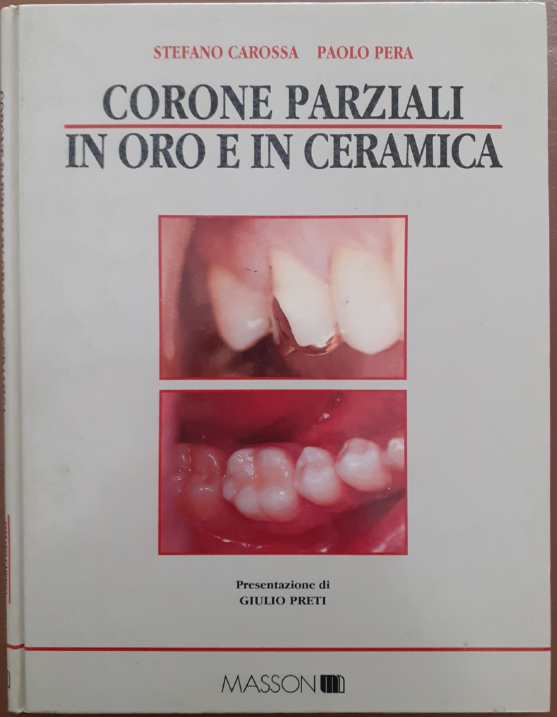 Carossa, Pera, Corone parziali in oro e in ceramica