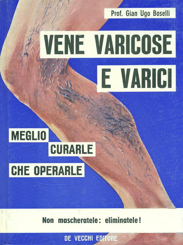 Vene varicose e varici