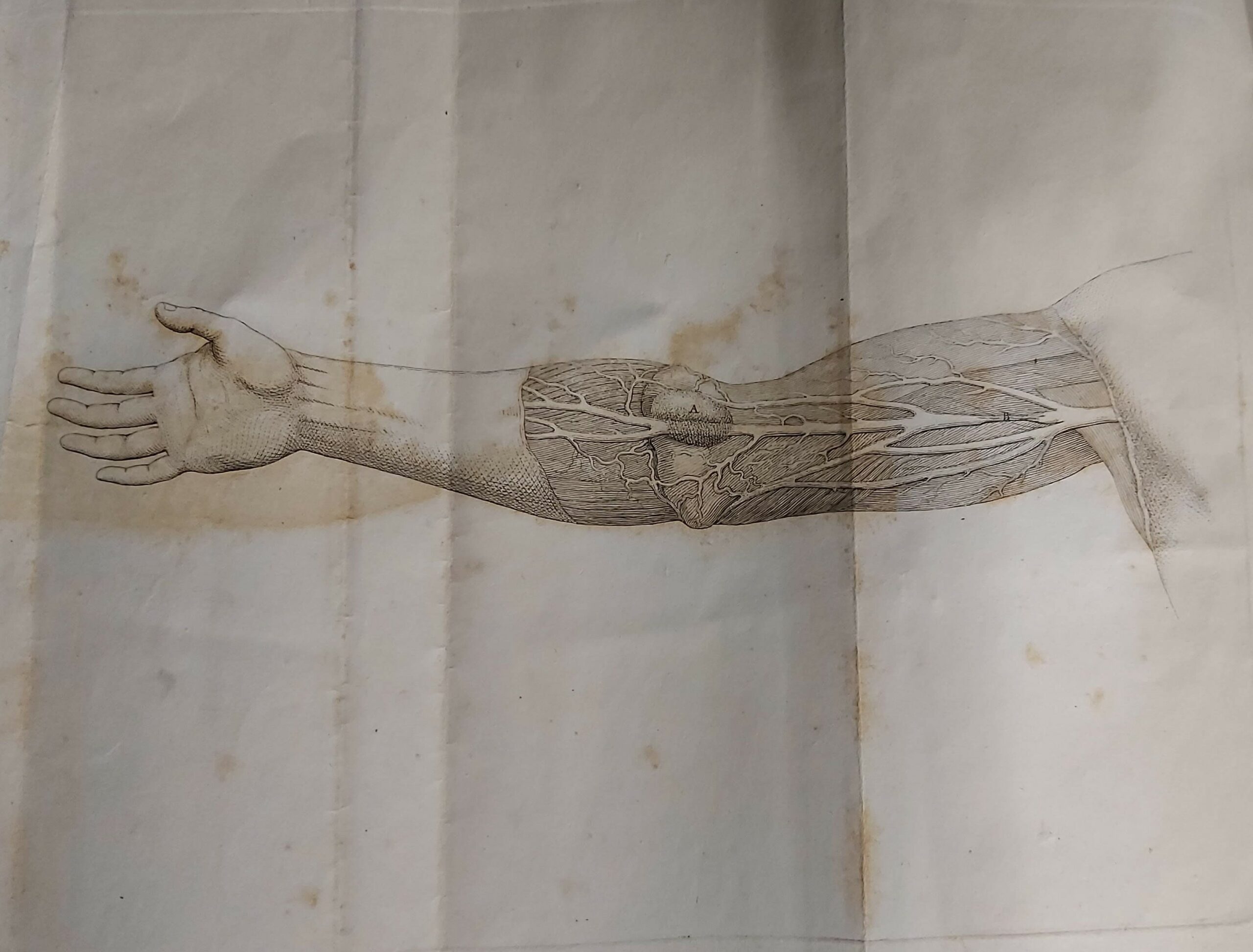 ESAME DEL BRACCIO D’UN UOMO stato operato per aneurisma col …