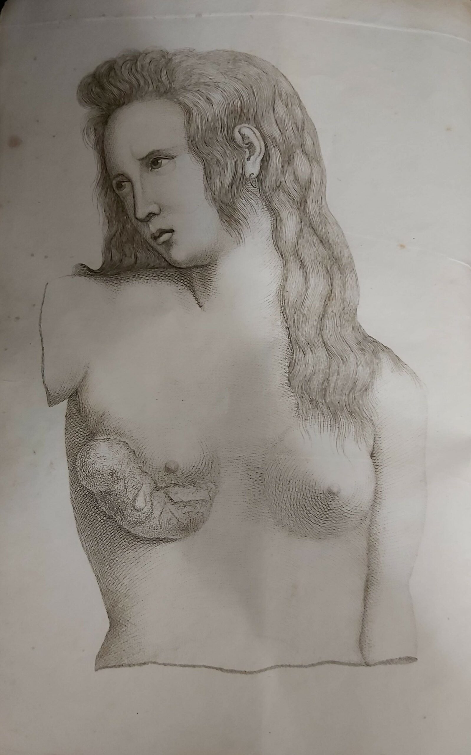 SOPRA UN VASTO ed antico Tumore alla mammella. Dissertazione.