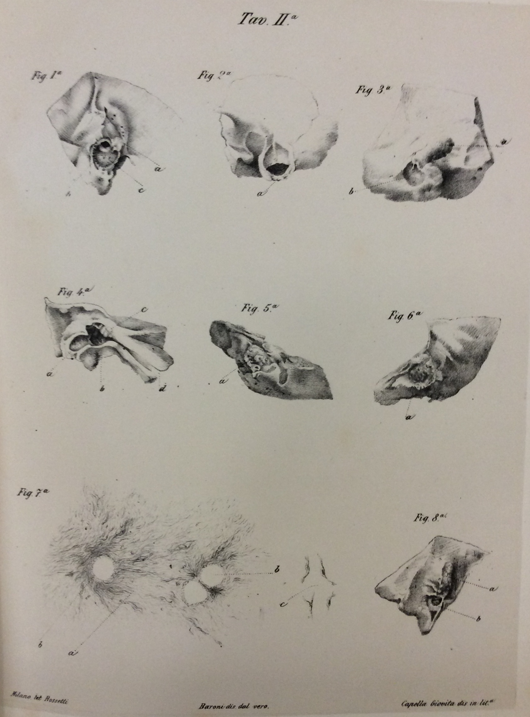 OSSERVAZIONI ANATOMICHE SULLA PATOLOGIA DELL'ORECCHIO.