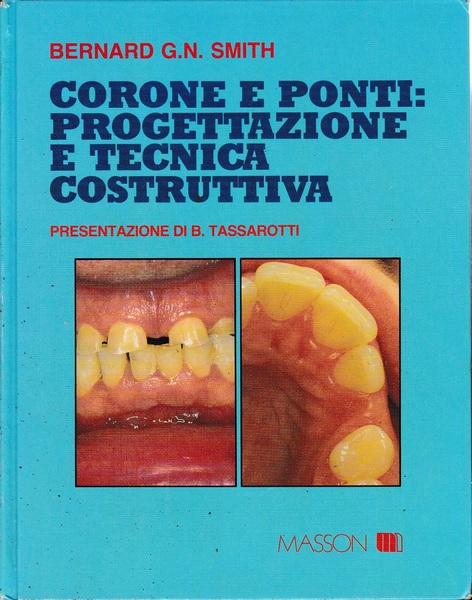 Corone e ponti: progettazione e tecnica costruttiva