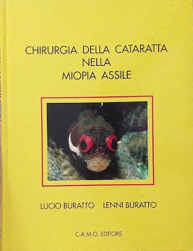 Chirurgia della cataratta nella miopia assile