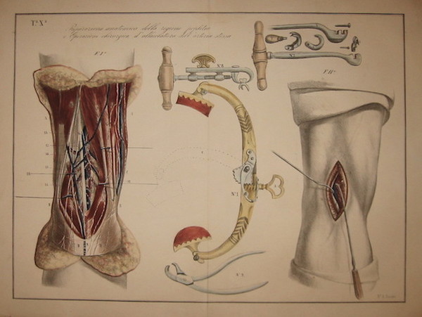 Tavola X. Preparazione anatomica della regione poplitea e operazione chirurgica …