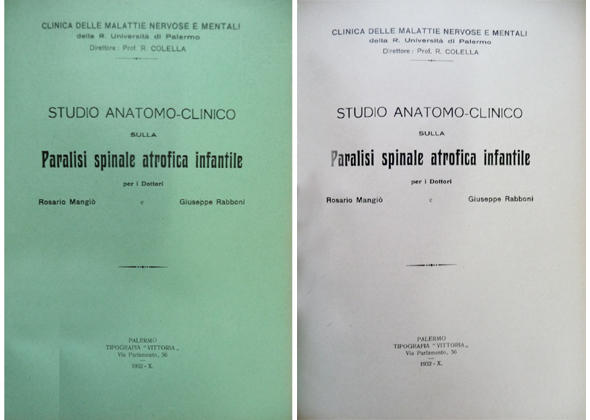 Studio anatomo - clinico sulla Paralisi spinale atrofica infantile.