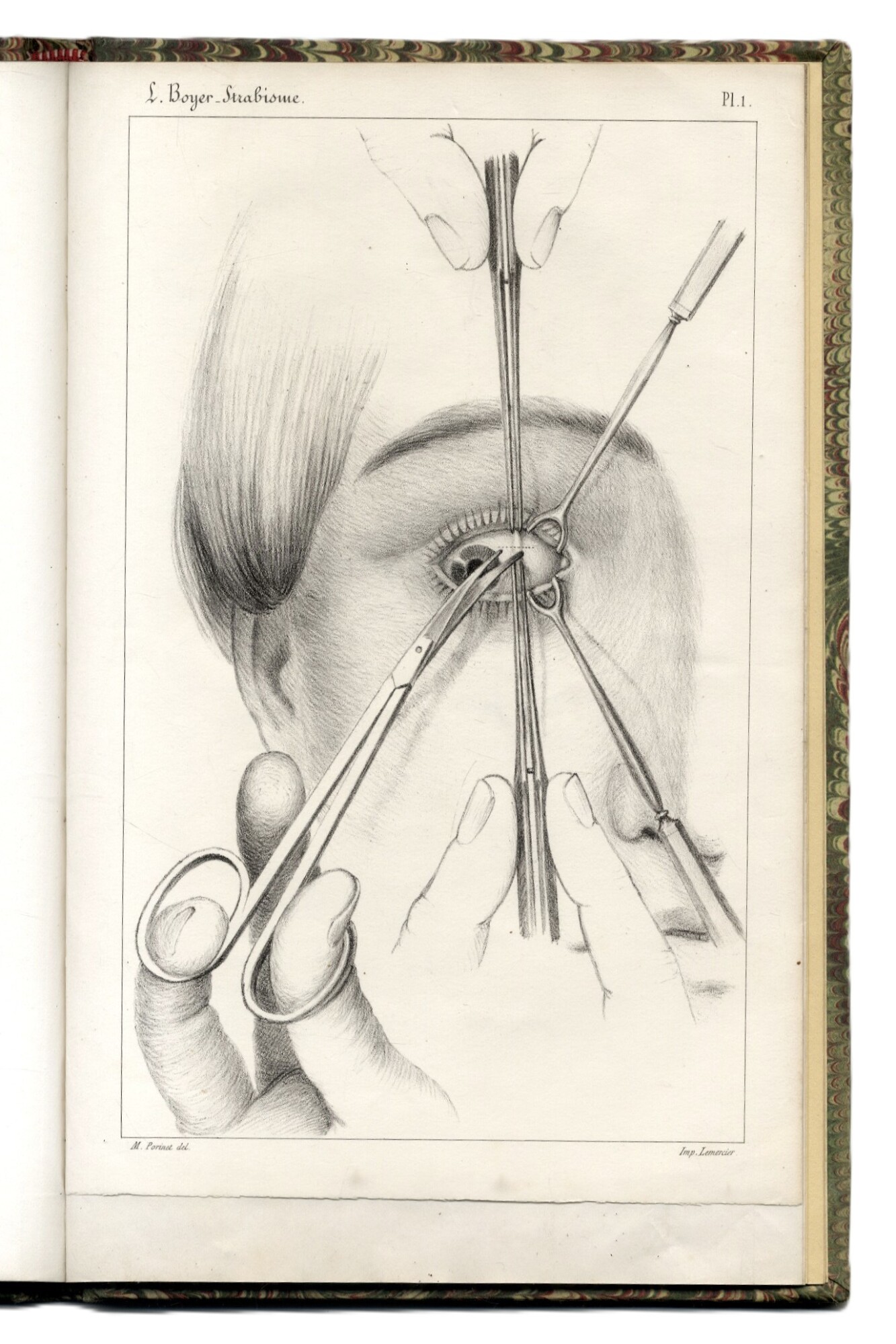 Recherches sur L'op&amp;eacute;ration du strabisme. Deuxi&amp;egrave;me M&amp;eacute;moire.