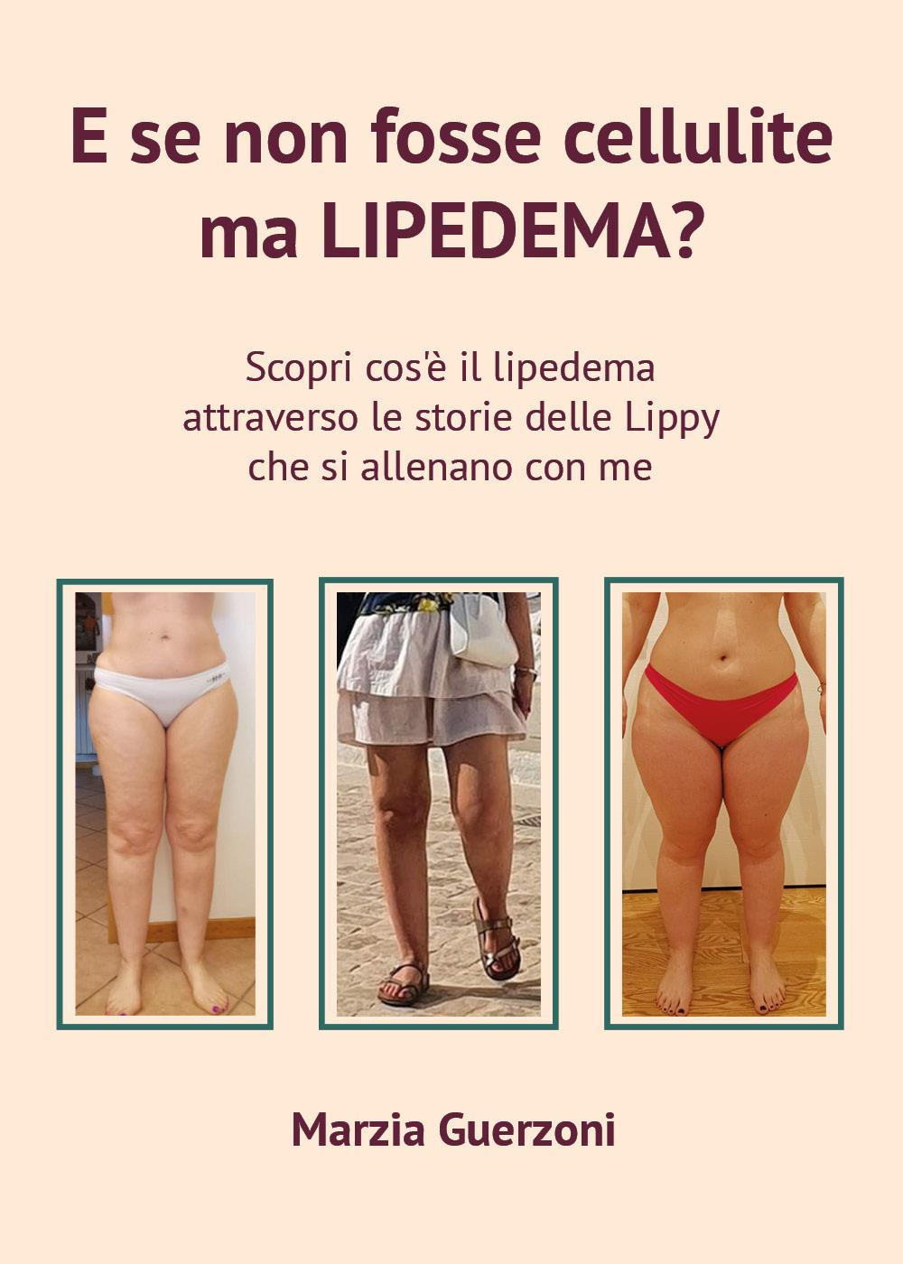 E se non fosse cellulite ma lipedema?