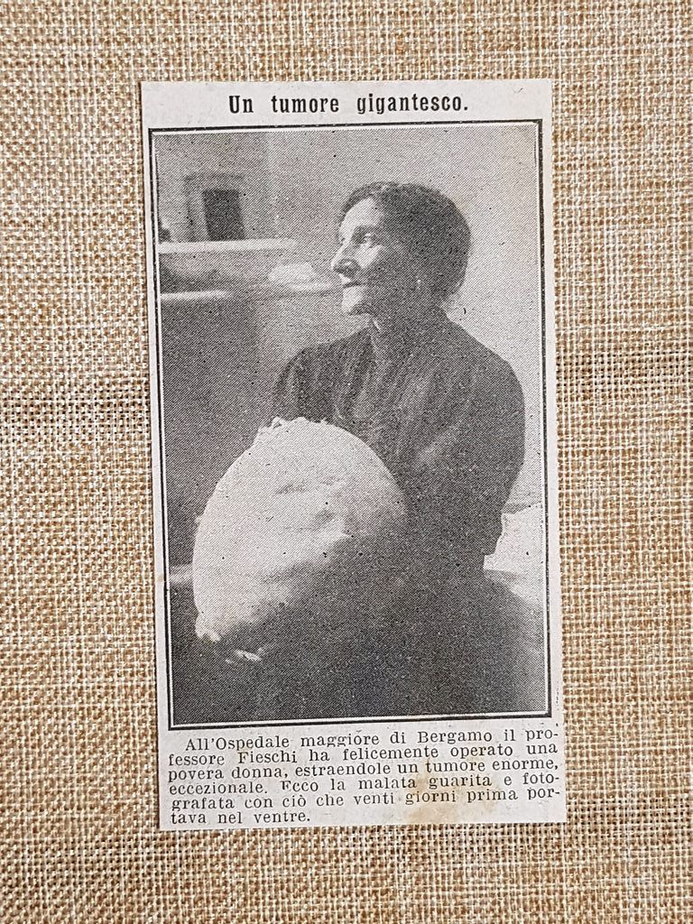 Bergamo nel 1914 Donna e il suo enorme tumore operato …