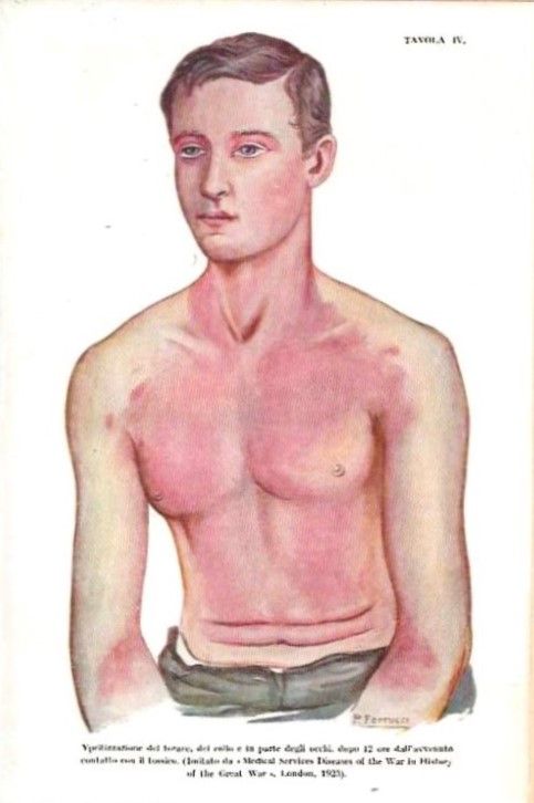 Fisioptologia e clinica dei Gas da combattimento, ad uso dei …