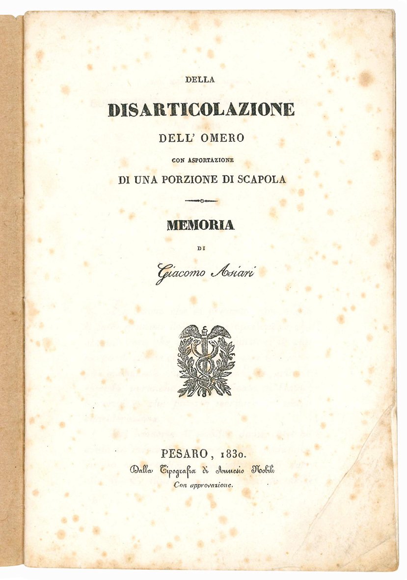 Della disarticolazione dell'omero con asportazione di una porzione di scapola.