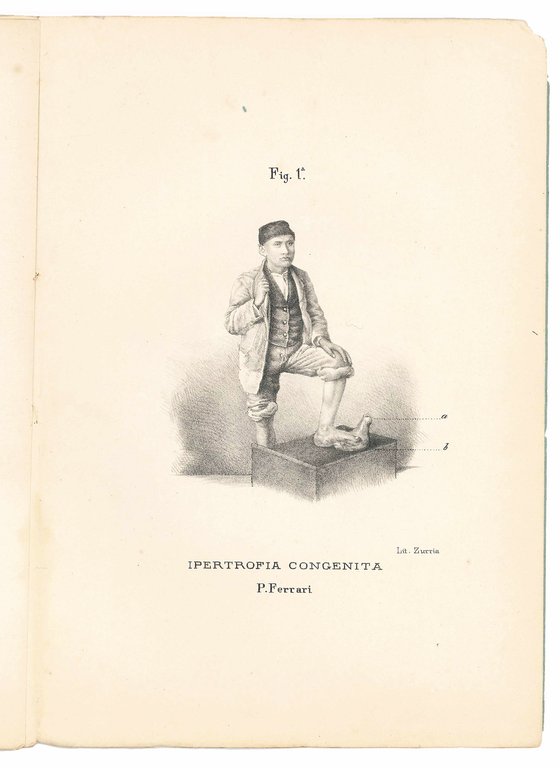 Della pachydermia (elefantiasi degli arabi) del dottor Primo Ferrari [...] … | Immagine Gallery 2