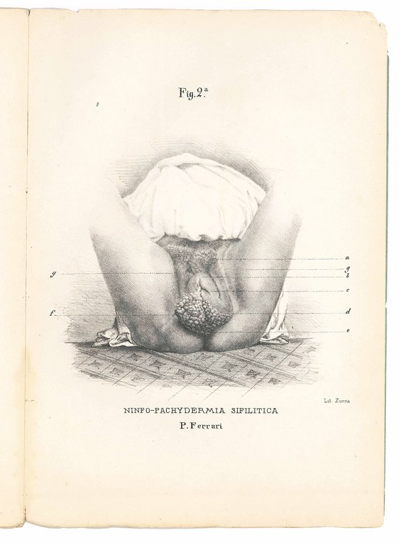 Della pachydermia (elefantiasi degli arabi) del dottor Primo Ferrari [...] … | Immagine Gallery 4