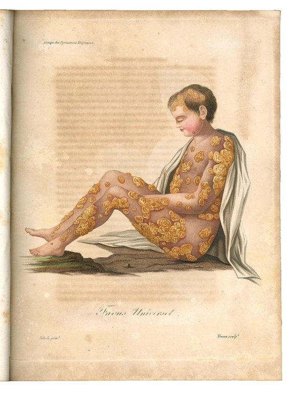 Monographie des dermatoses ou precis theorique et pratique des maladies …