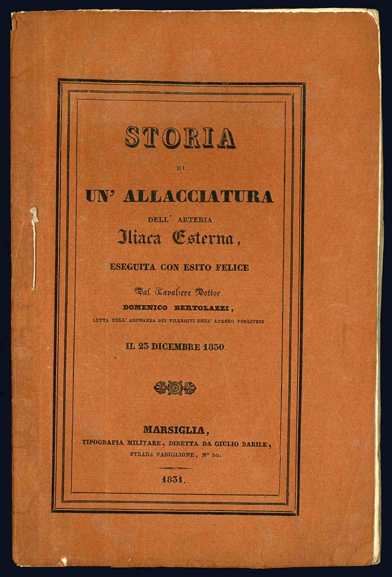 Storia di un'allacciatura dell'arteria iliaca esterna, eseguita con esito felice …
