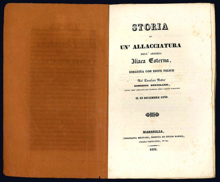 Storia di un'allacciatura dell'arteria iliaca esterna, eseguita con esito felice …