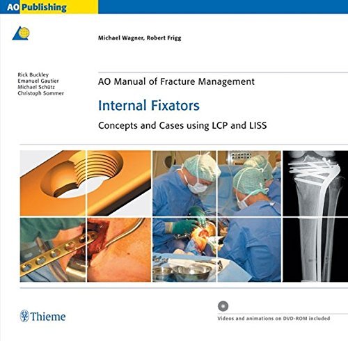 Ao Manual of Fracture Management: Internal Fixators: Concepts and Cases …