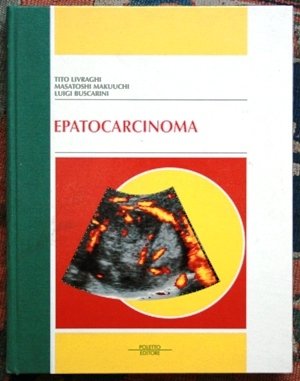 epatocarcinoma