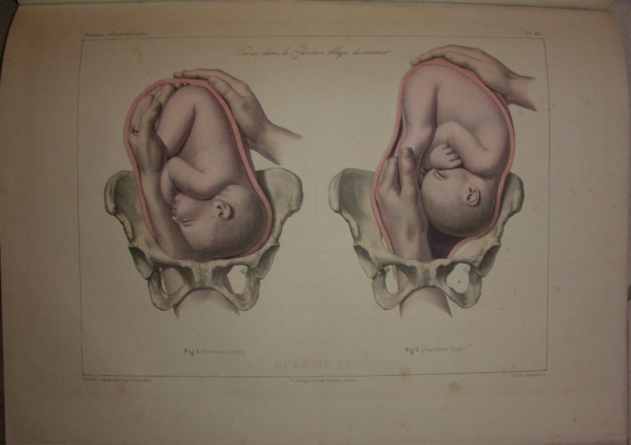 TRAITE PRATIQUE DES ACCOUCHEMENS par. Atlas de planches executees d'apres …