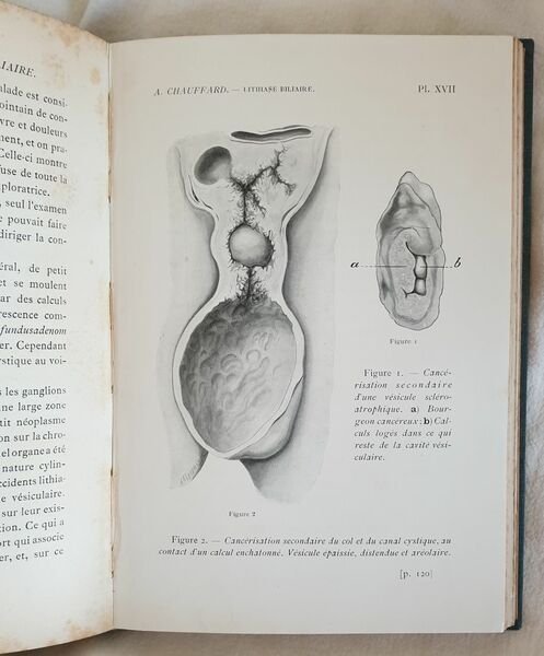 CLINIQUE MEDICALE DE SAINT ANTOINE LECONS SUR LA LITHIASE BILIAIRE