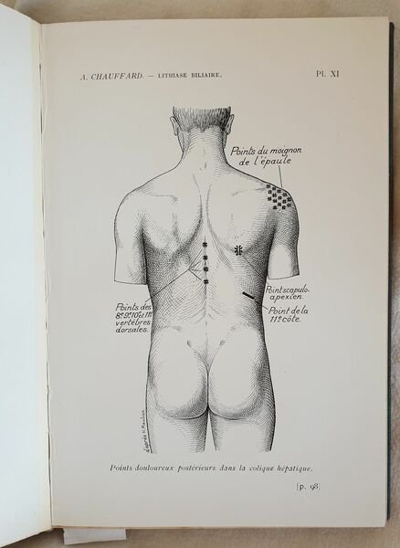 CLINIQUE MEDICALE DE SAINT ANTOINE LECONS SUR LA LITHIASE BILIAIRE