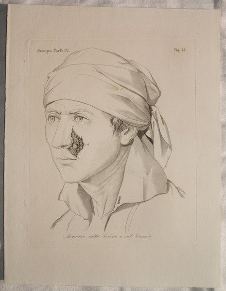 MEMORIA SULLO SCIRRO E SUL CANCRO