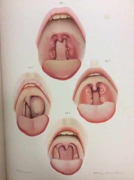 ATLAS DER KRANKHEITEN DER MUND-UND RACHENHOHLE.
