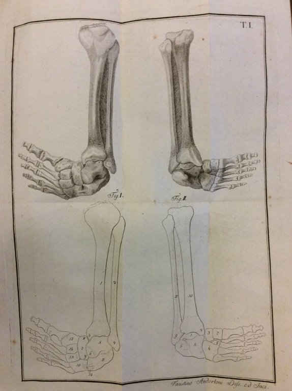 MEMORIA CHIRURGICA SUI PIEDI TORTI CONGENITI DEI FANCIULLI E SULLA …