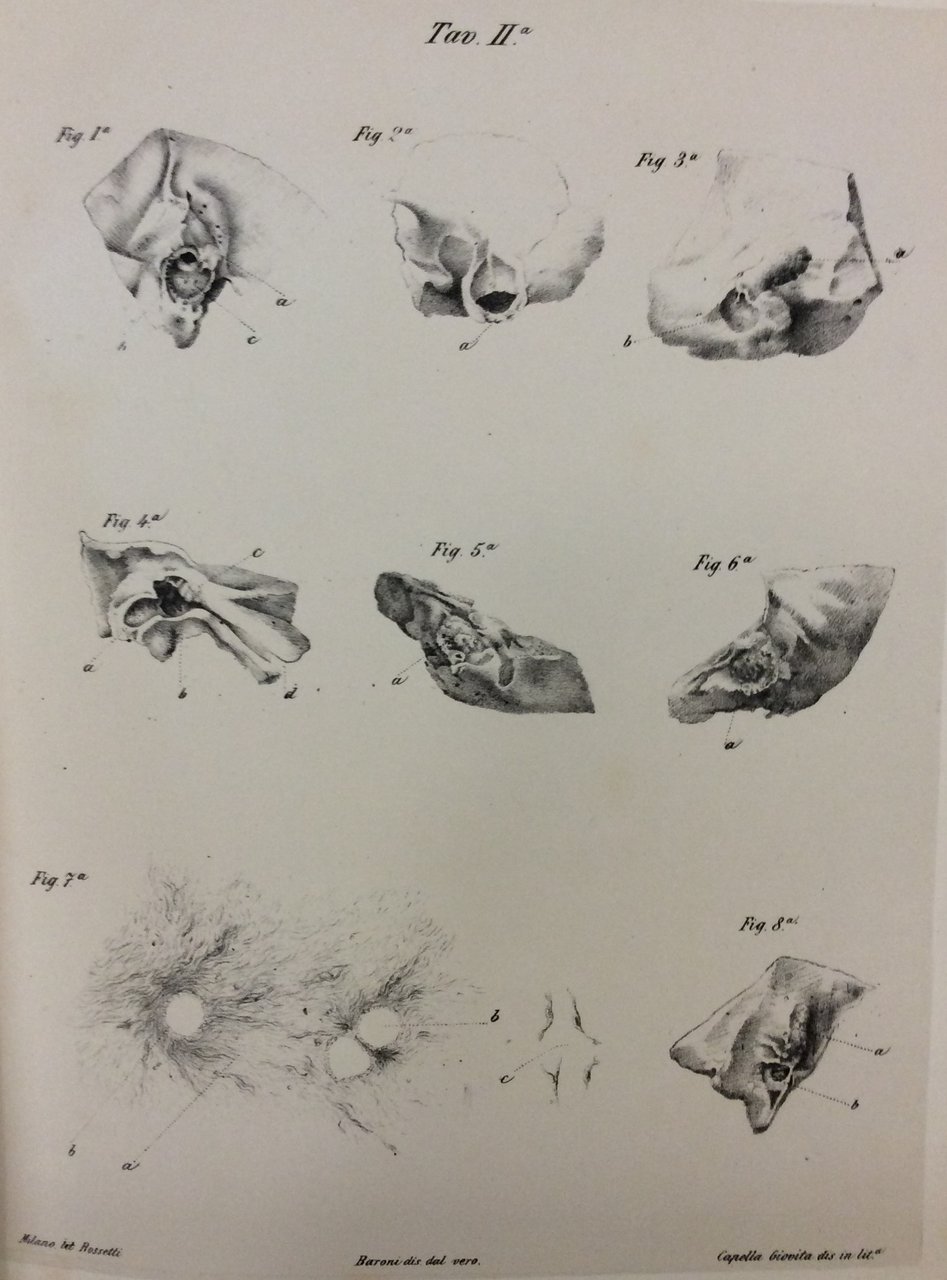 OSSERVAZIONI ANATOMICHE SULLA PATOLOGIA DELL'ORECCHIO.