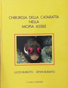 Chirurgia della cataratta nella miopia assile