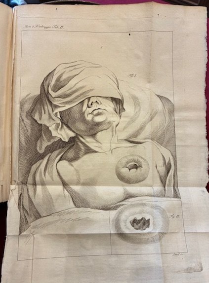 Scriptorum latinorum de aneurysmatibus collectio. Lancisius, Guattani, Matani, Verbrugge, Weltinus, …