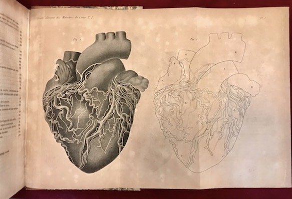 Traité clinique des maladies du coeur, precedé de recherches nouvelles …