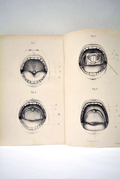 [ Le Laryngoscope à Cauterets. Etude sur le Gargarisme Laryngien. …