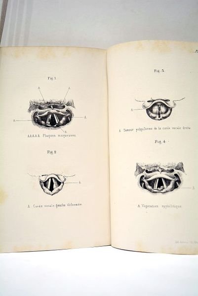 [ Le Laryngoscope à Cauterets. Etude sur le Gargarisme Laryngien. …