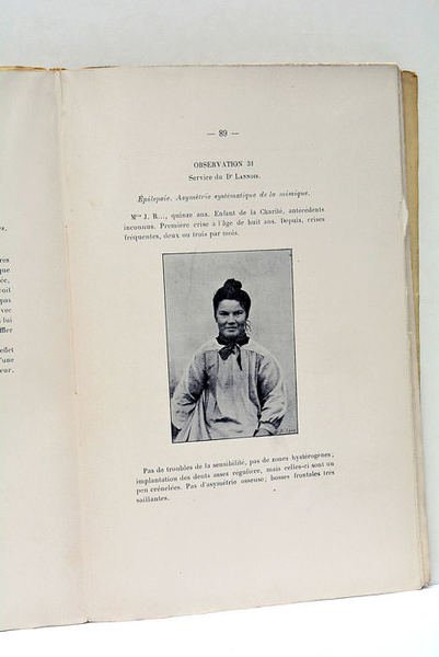 La mimique faciale. De l'Hémi-mimie faciale d'origine otique.