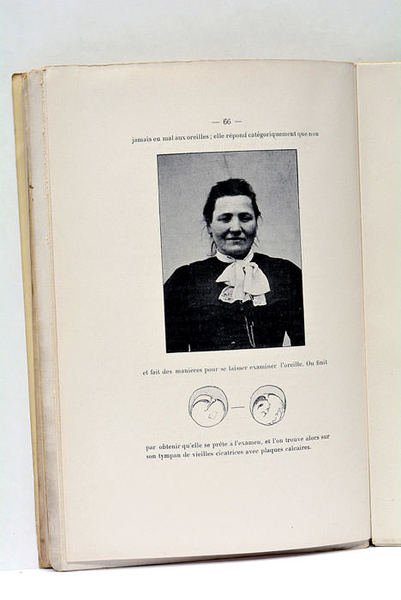 La mimique faciale. De l'Hémi-mimie faciale d'origine otique.