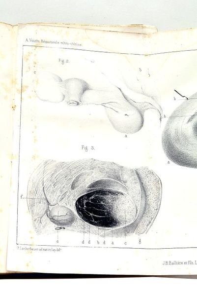 De l'Hématocèle Rétro-Utérine et des épanchements sanguins non enkystés de …