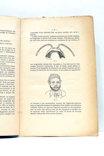 Du Traitement des Fractures du Maxillaire Inférieur par un Nouvel …