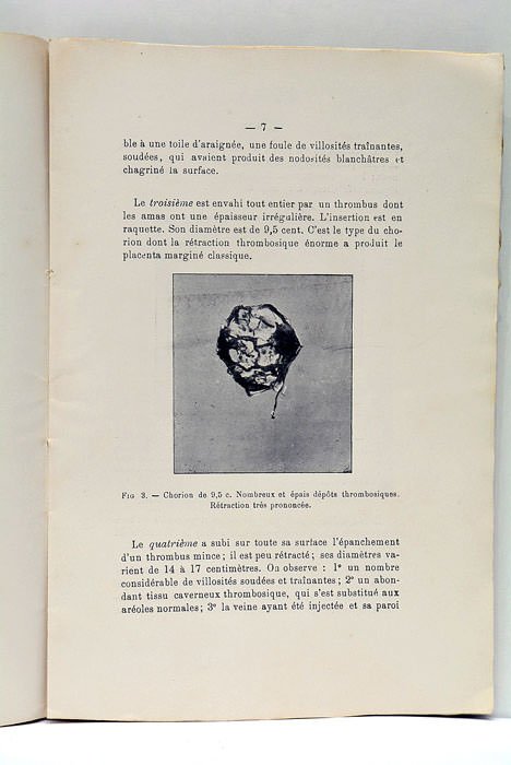 Chorion et Thrombose. Avec 8 figures.
