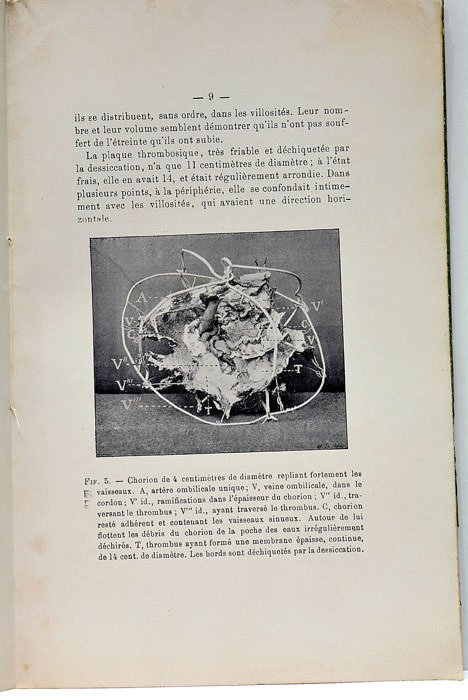 Chorion et Thrombose. Avec 8 figures.