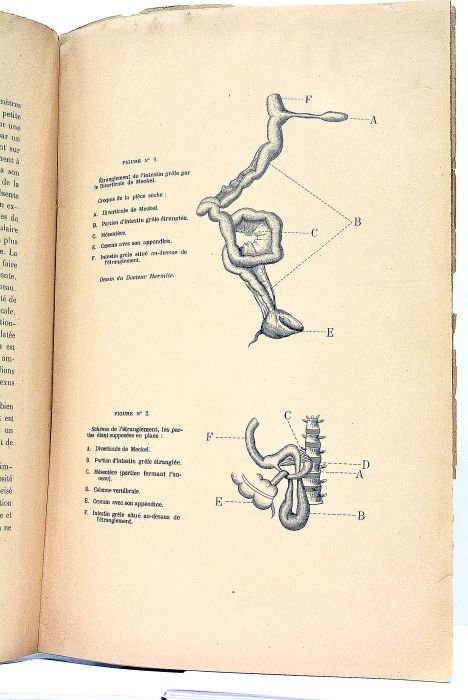 Considérations à propos de deux cas d'Etranglement Aigu de l'Intestin …