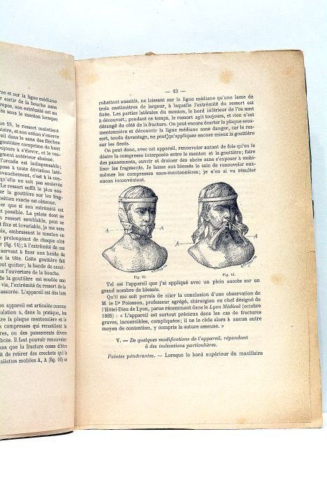 Du Traitement des Fractures du Maxillaire Inférieur par un Nouvel …
