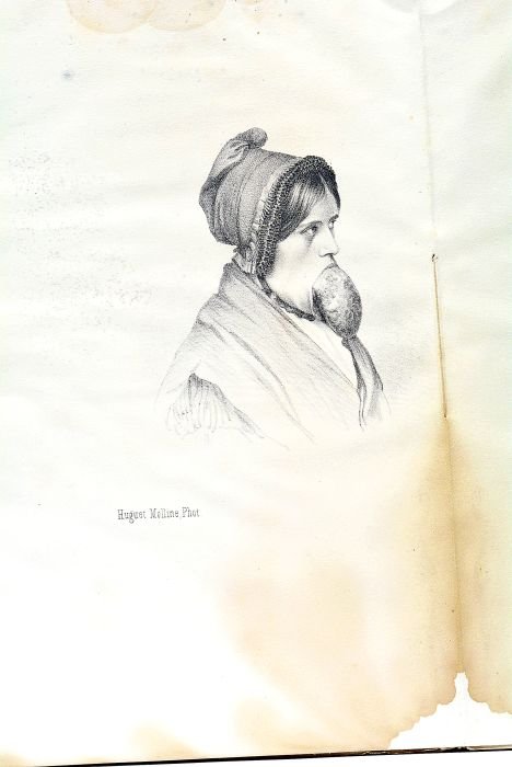 Etude sur le Prolapsus Hypertrophique de la Langue.