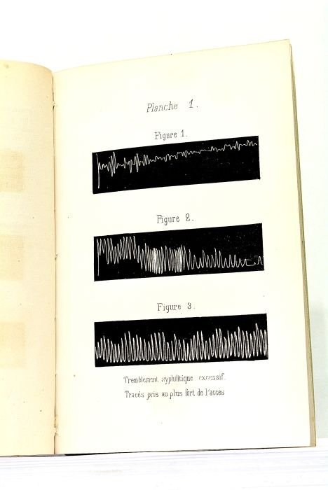 Etude sur le tremblement syphilitique.