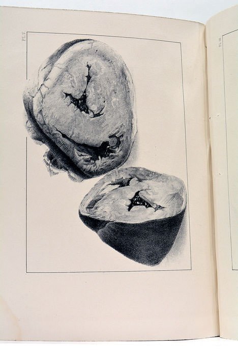 Etudes physiologiques et cliniques pour servir à l'histoire des bruits …