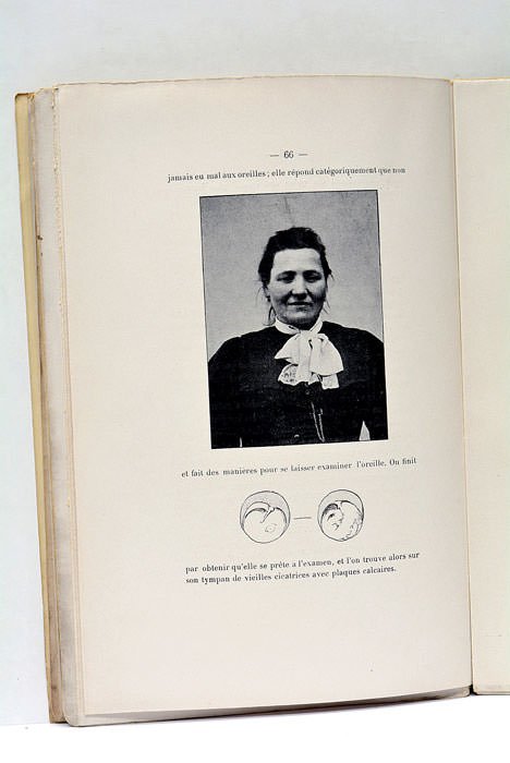 La mimique faciale. De l'Hémi-mimie faciale d'origine otique.