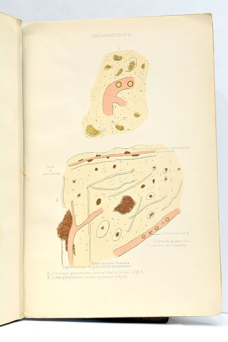 Recherches sur l'anatomie pathologique et la nature de la paralysie …