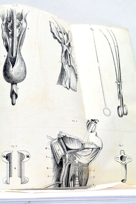Rétrécissements de l'Oesophage.